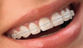 Clear braces
