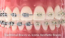 Iconix braces