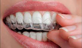 Invisalign