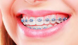 Traditional braces
